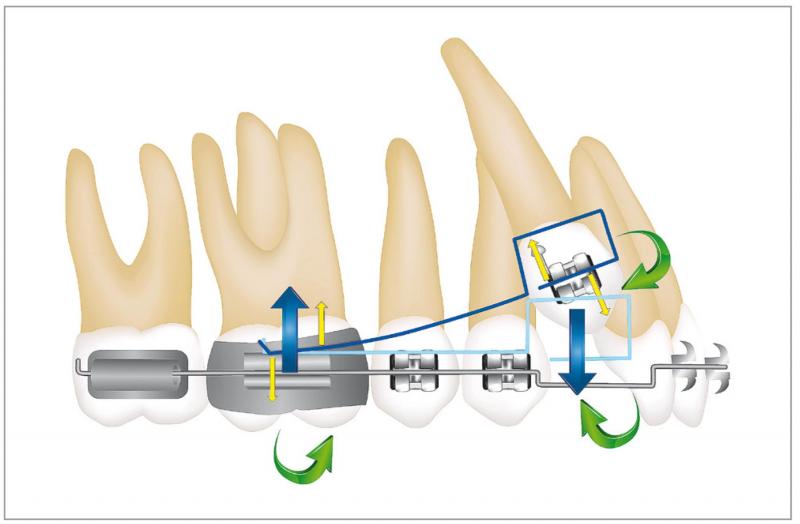 Looking for Orthodontic Care in Lakewood Ranch or Sarasota. 15 Must-Know Tips for Finding the Best Orthodontist