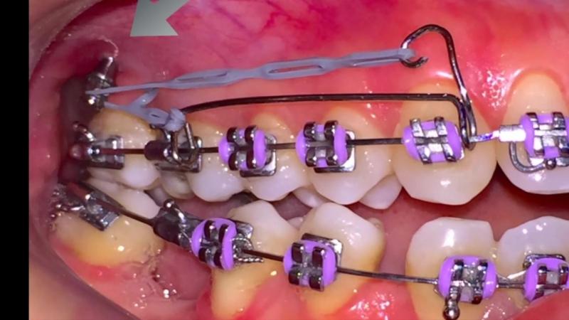 Looking for Orthodontic Care in Lakewood Ranch or Sarasota. 15 Must-Know Tips for Finding the Best Orthodontist