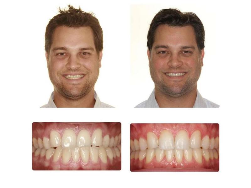 Looking for Orthodontic Care in Lakewood Ranch or Sarasota. 15 Must-Know Tips for Finding the Best Orthodontist