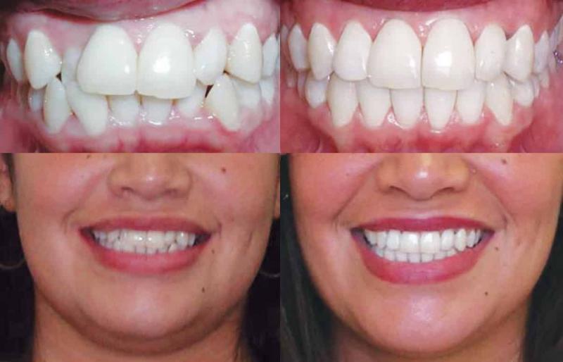 Looking for Orthodontic Care in Lakewood Ranch or Sarasota. 15 Must-Know Tips for Finding the Best Orthodontist
