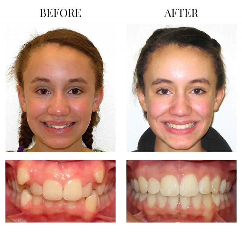 Looking for Orthodontic Care in Lakewood Ranch or Sarasota. 15 Must-Know Tips for Finding the Best Orthodontist