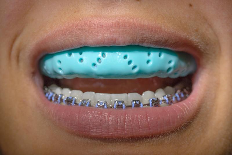 Ready to Protect Your Teeth During Sports: Why a Custom Gladiator Mouthguard is Your Best Option
