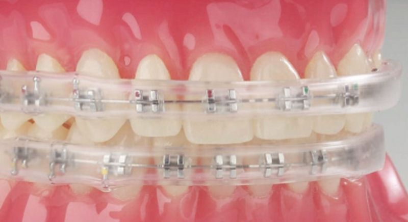 Searching for the Perfect Mouthguard With Braces Consider These Key Points