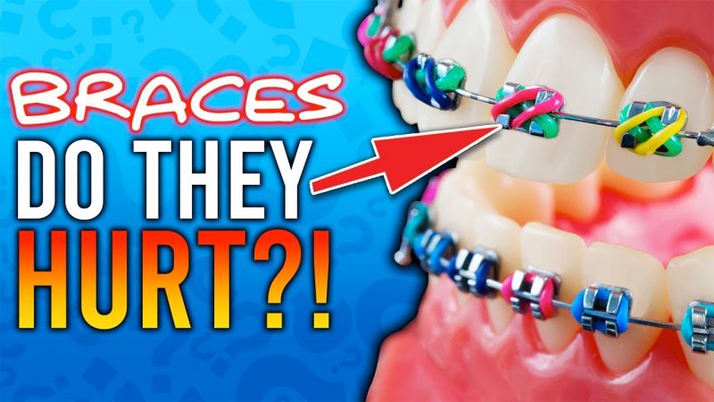 Searching for the Perfect Mouthguard With Braces Consider These Key Points