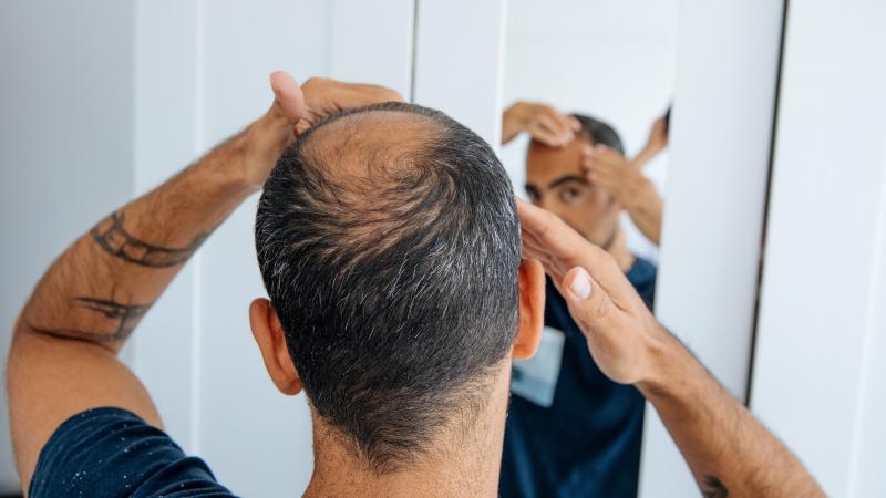 Sun Hats for Balding Men: The 14 Best Options to Protect Your Scalp This Summer