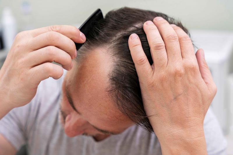 Sun Hats for Balding Men: The 14 Best Options to Protect Your Scalp This Summer