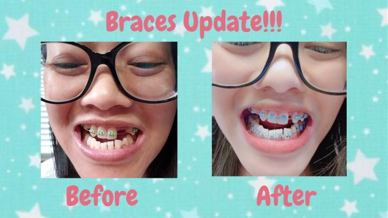 Tasty Mouthguards for Braces: 15 Fun Ways to Make Wearing Orthodontics More Enjoyable