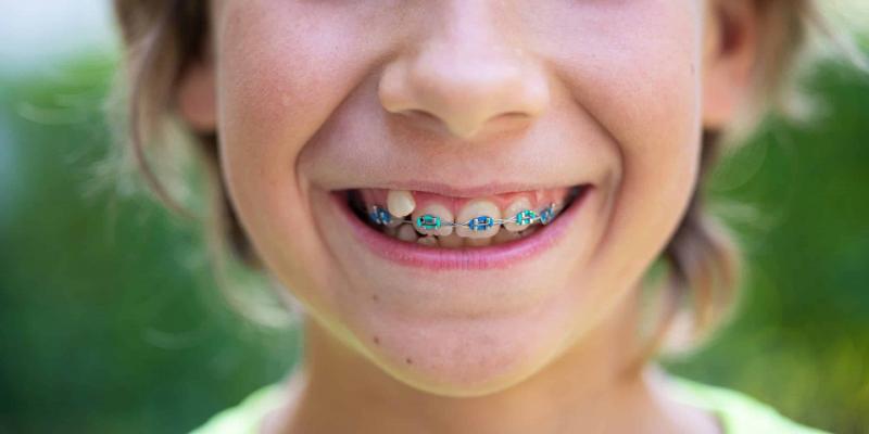 The Best Field Hockey Mouthguards for Braces: Save Your Teeth from Disaster This Season