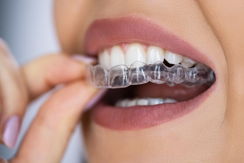 Transform Your Gameplay Instantly: The Best Mouthguards For Braces That Fit Comfortably