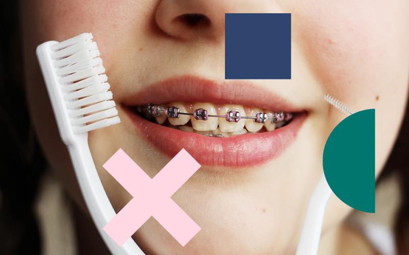 Transform Your Gameplay Instantly: The Best Mouthguards For Braces That Fit Comfortably