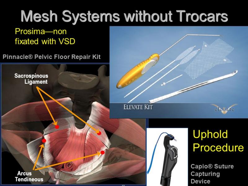 Want Perfect Pocket in Your Lacrosse Stick: Use These 15 String King Mesh Kit Tips