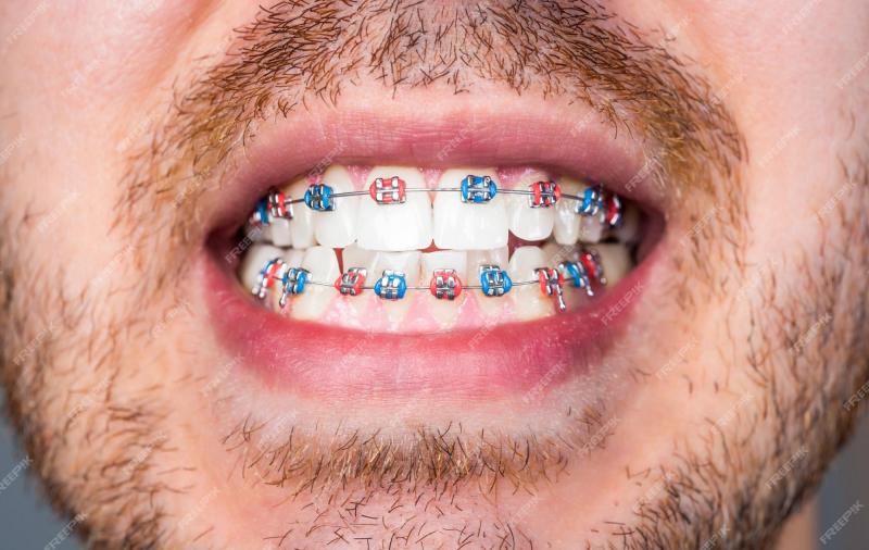 Youth Braces Mouthguards: The 15 Best Options to Protect Your Teeth in 2023